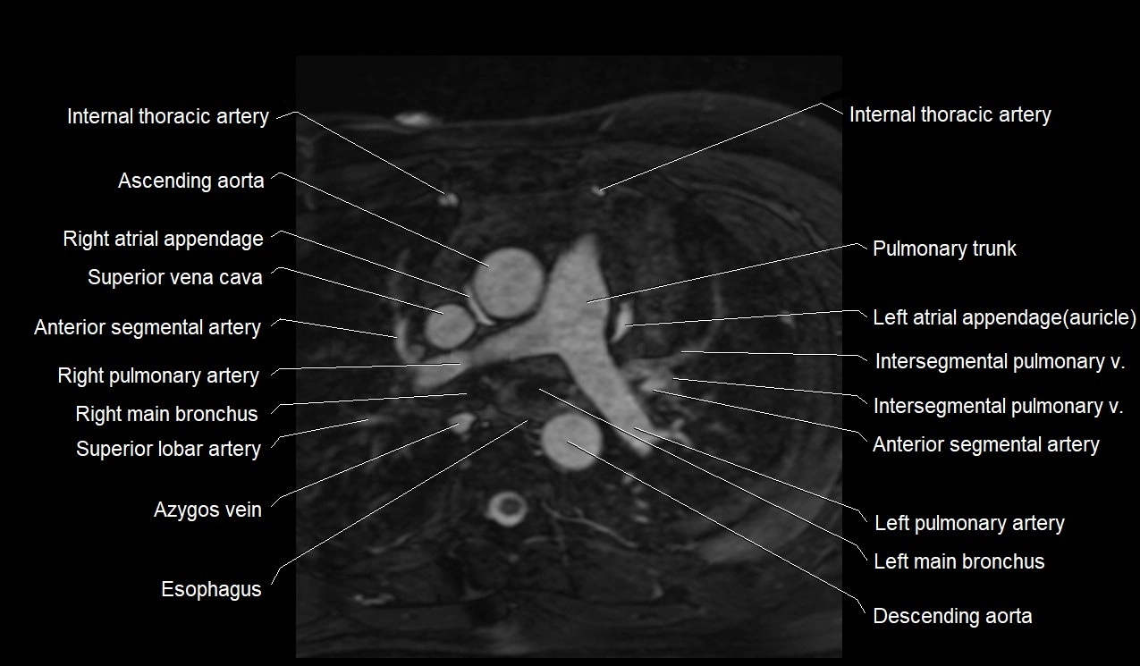 MRI heart coronary arteries and coronary veins anatomy axial image 3.webp